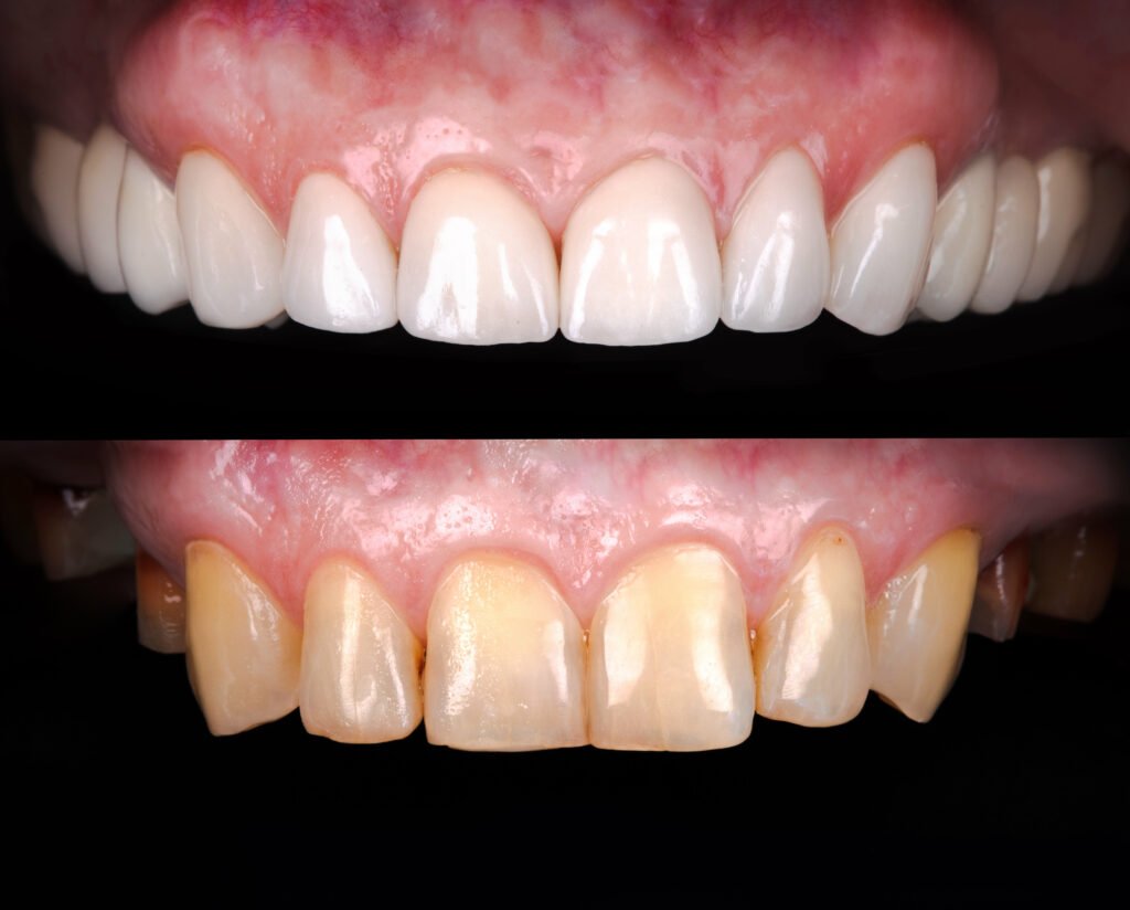 before and after smile makeover pictures