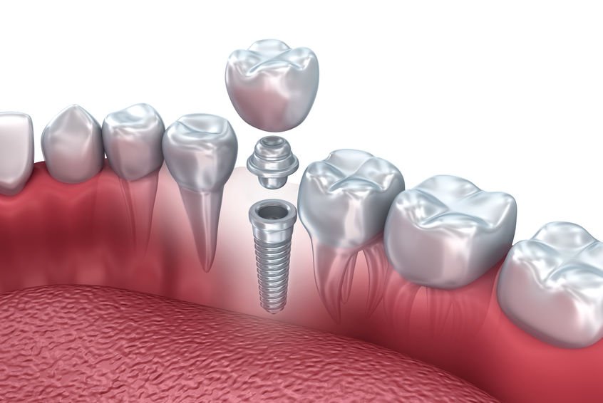 dental implant illustration with crown