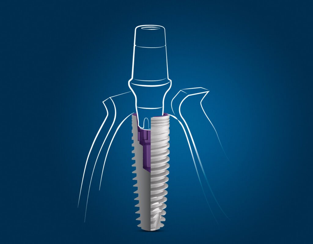 dental implant drawing