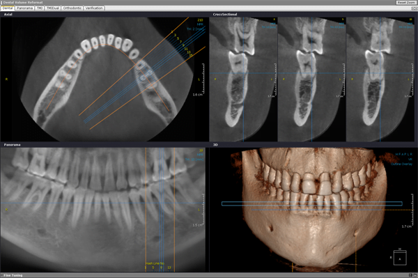 3D cone beam X ray