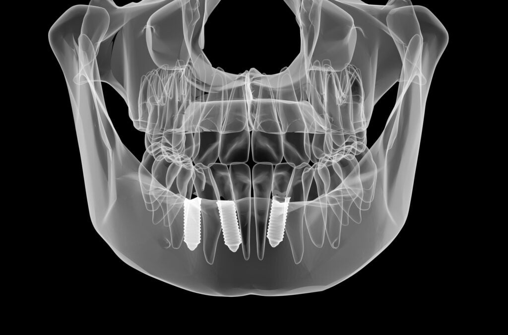dental implants picture with CBCT scan
