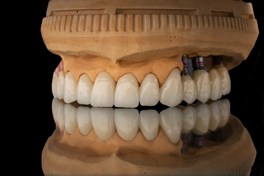 full mouth rehabilitation with crowns and implants