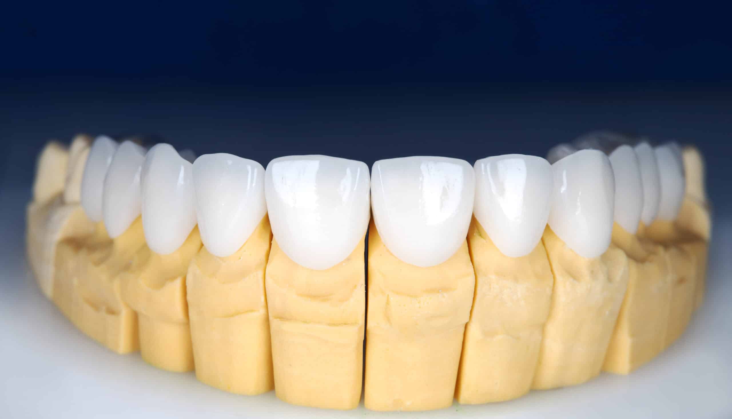 dreamstime_xxl_216766315 Perfected porcelain veneers and dental model for smile makeover transformation.
