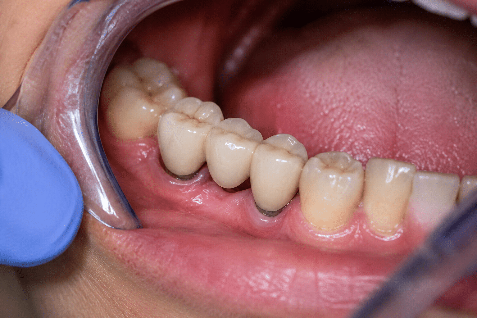 Dental Bridges