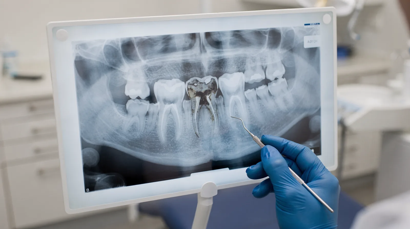 When Is a Root Canal Needed